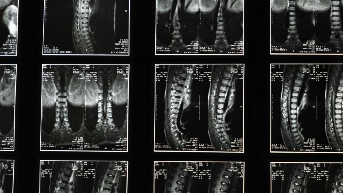 Investigadors de la UPF desenvolupen models virtuals per simular cirurgies de columna i reduir complicacions