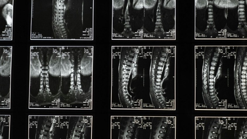 Els models virtuals corregeixen la deformitat de la columna en adults, una patologia que altera l’alineació vertebral i l’equilibri postural del pacient